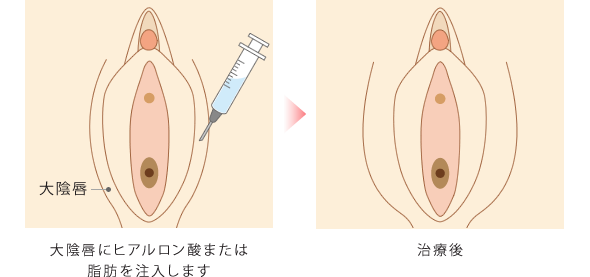 大陰唇増大術の流れ